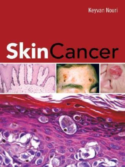 Skin Cancer