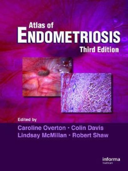 Atlas of Endometriosis