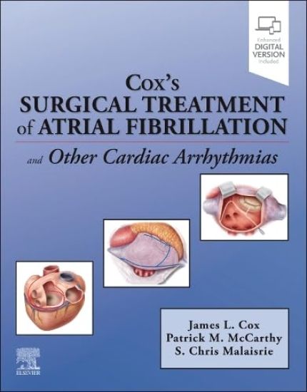 Cox's Surgical Treatment of Atrial Fibrillation
