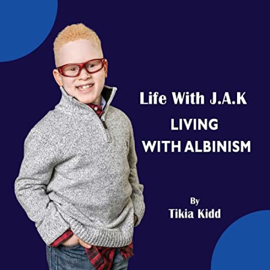 Life With J.A.K Living with Albinism