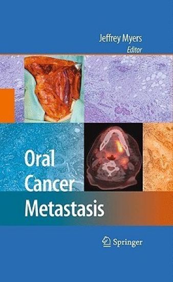 Oral Cancer Metastasis