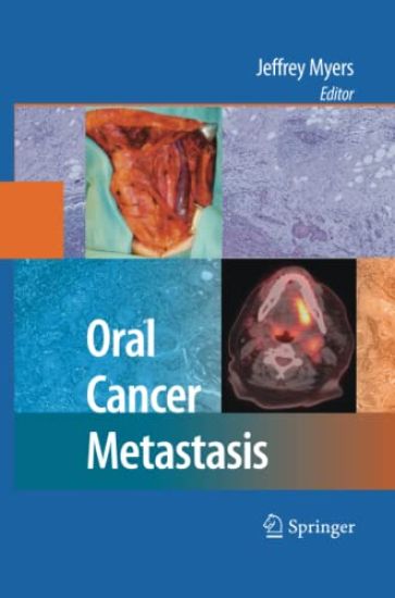 Oral Cancer Metastasis
