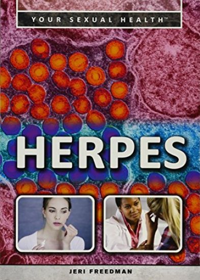 Herpes