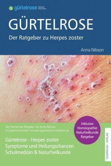 Gürtelrose - Der große Ratgeber zu Herpes zoster: Schulmedizin + Naturheilkunde