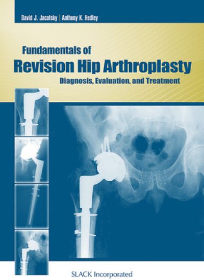 Fundamentals of Revision Hip Arthroplasty