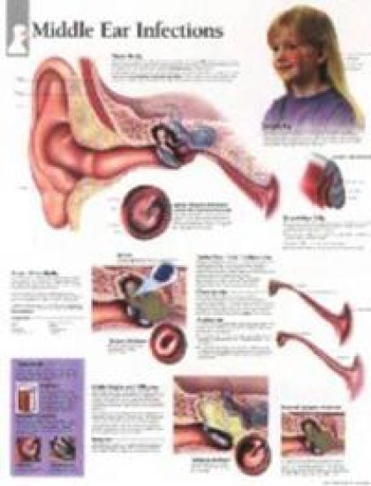 Middle Ear Infections Laminated Poster