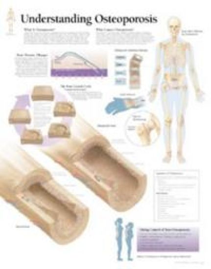 Understanding Osteoporosis Paper Poster