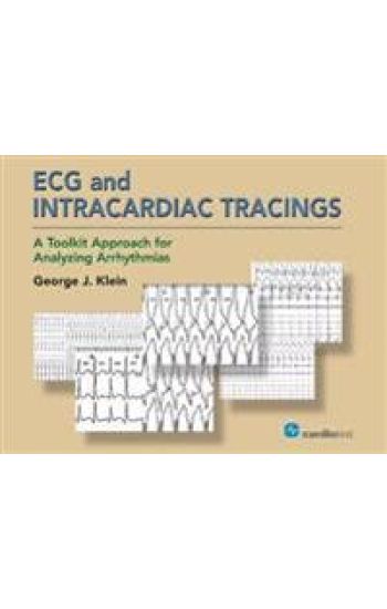 ECG and Intracardiac Tracings