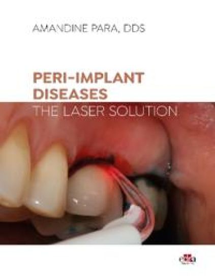 Peri-implant Diseases: The Laser Solution