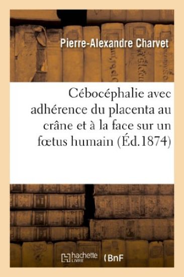 Cébocéphalie Avec Adhérence Du Placenta Au Crâne Et À La Face Sur Un Foetus Humain