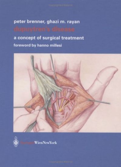 Dupuytren’s Disease