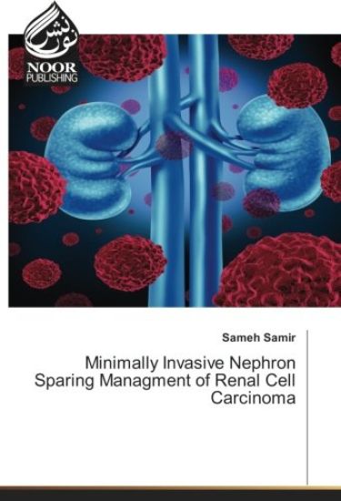 Minimally Invasive Nephron Sparing Managment of Renal Cell Carcinoma
