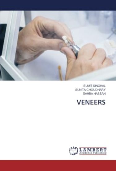 Veneers