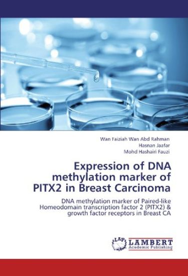 Expression of DNA methylation marker of PITX2 in Breast Carcinoma