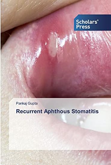 Recurrent Aphthous Stomatitis