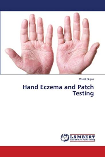 Hand Eczema and Patch Testing