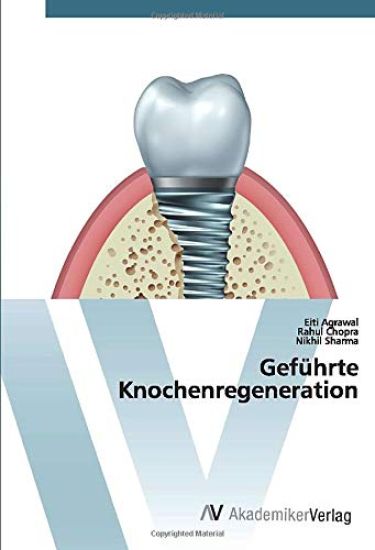 Geführte Knochenregeneration
