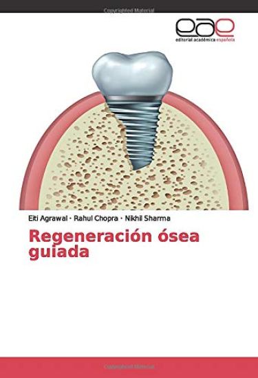 Regeneración ósea guiada