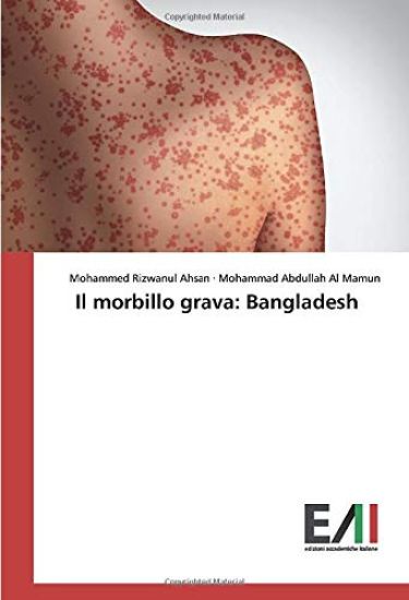 Il morbillo grava: Bangladesh
