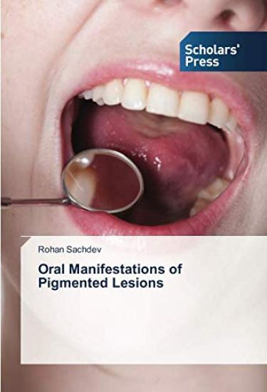 Oral Manifestations of Pigmented Lesions