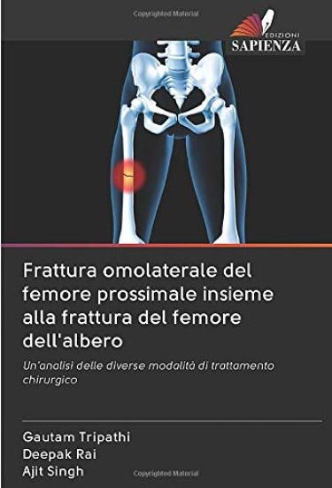 Frattura omolaterale del femore prossimale insieme alla frattura del femore dell'albero