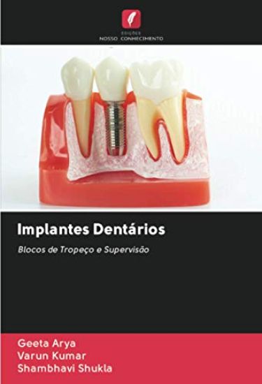 Implantes Dentários