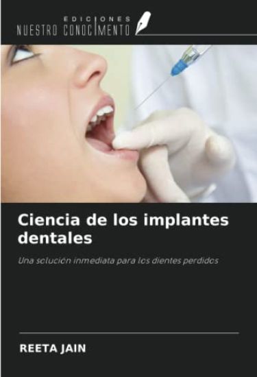 Ciencia de los implantes dentales