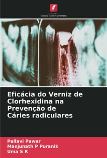 Eficácia do Verniz de Clorhexidina na Prevenção de Cáries radiculares