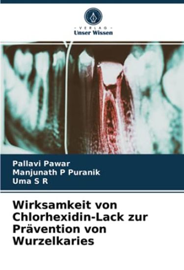 Wirksamkeit von Chlorhexidin-Lack zur Prävention von Wurzelkaries