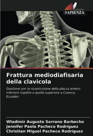 Frattura mediodiafisaria della clavicola