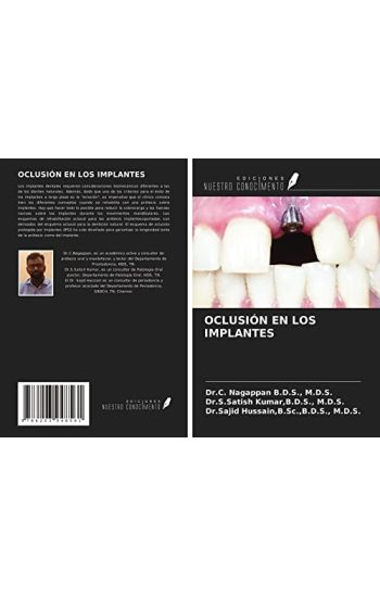 OCLUSIÓN EN LOS IMPLANTES