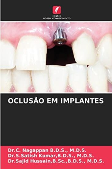 Oclusão Em Implantes