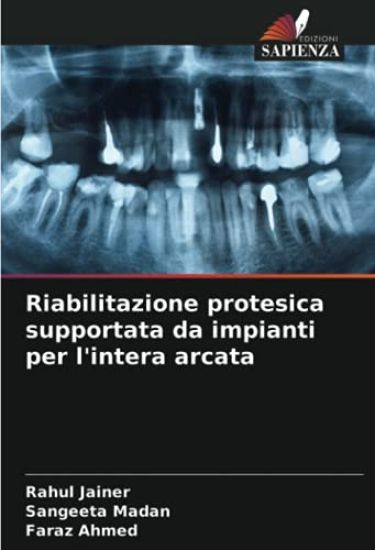 Riabilitazione protesica supportata da impianti per l'intera arcata