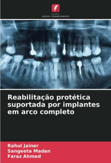 Reabilitação protética suportada por implantes em arco completo