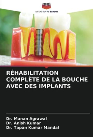 RÉHABILITATION COMPLÈTE DE LA BOUCHE AVEC DES IMPLANTS