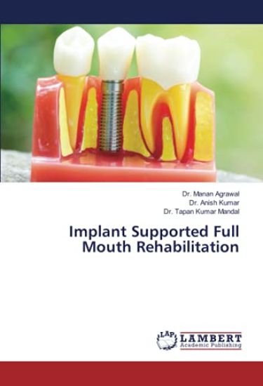Implant Supported Full Mouth Rehabilitation