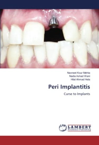 Peri Implantitis