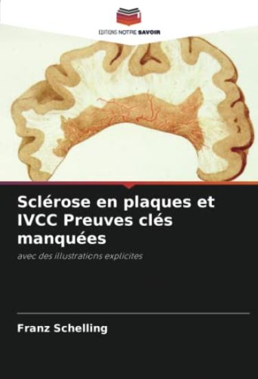 Sclérose en plaques et IVCC Preuves clés manquées