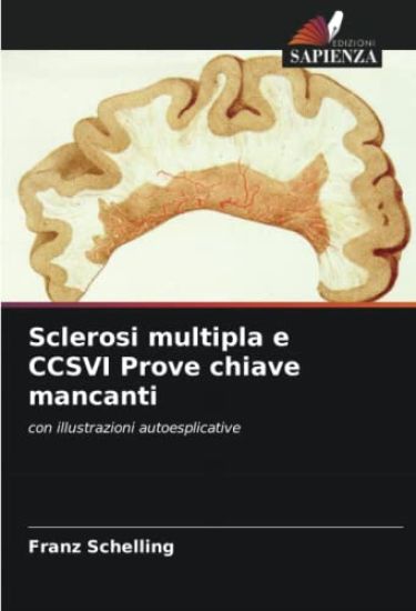 Sclerosi multipla e CCSVI Prove chiave mancanti