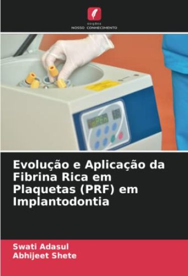 Evolução e Aplicação da Fibrina Rica em Plaquetas (PRF) em Implantodontia