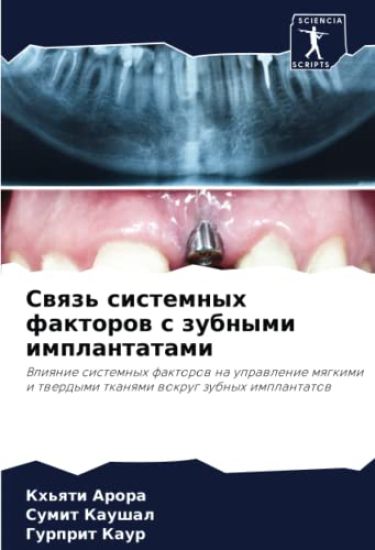 Swqz' sistemnyh faktorow s zubnymi implantatami