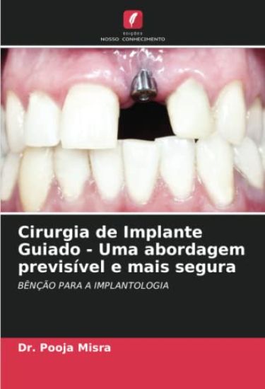 Cirurgia de Implante Guiado - Uma abordagem previsível e mais segura
