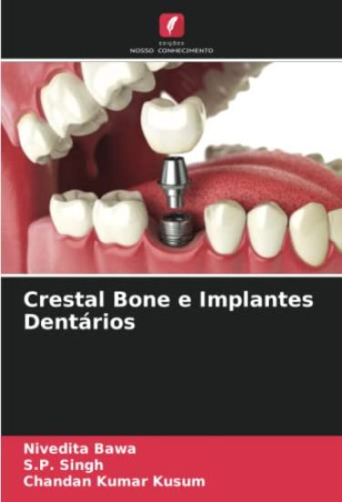 Crestal Bone e Implantes Dentários