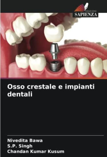 Osso crestale e impianti dentali