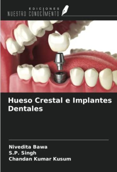 Hueso Crestal e Implantes Dentales
