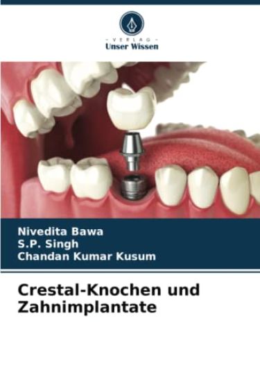 Crestal-Knochen und Zahnimplantate