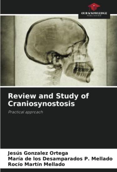 Review and Study of Craniosynostosis