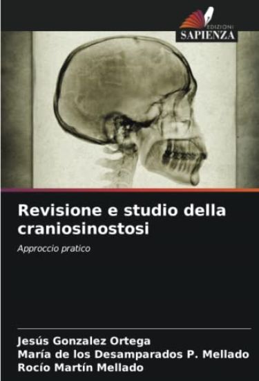 Revisione e studio della craniosinostosi