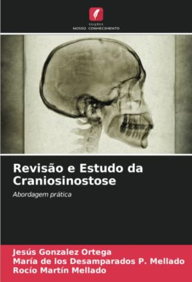 Revisão e Estudo da Craniosinostose