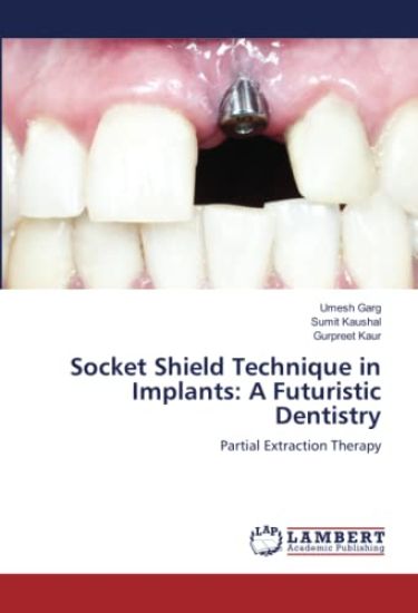 Socket Shield Technique in Implants: A Futuristic Dentistry